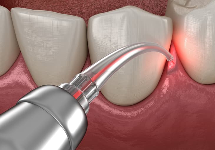 Soft Tissue Laser