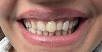 Smile gallery case 2, before