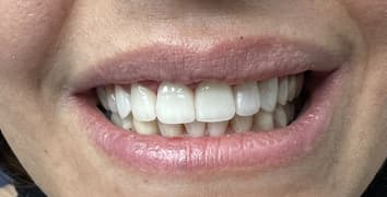 Smile gallery case 2, after