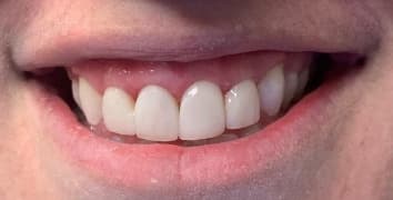 Smile gallery case 18, after