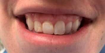 Smile gallery case 18, before