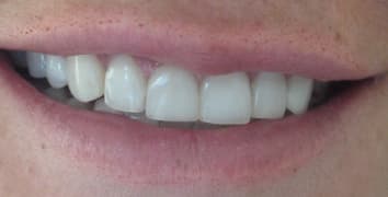 Smile gallery case 9, after