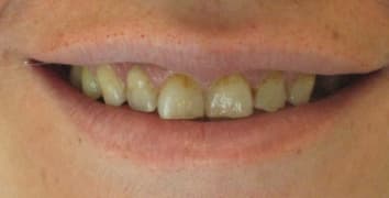 Smile gallery case 9, before