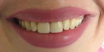 Smile gallery case 10, after
