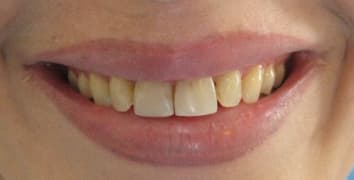 Smile gallery case 10, before
