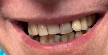 Smile gallery case 11, before