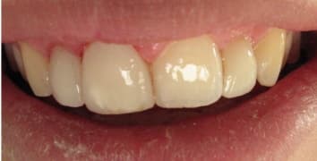 Smile gallery case 12, after