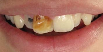 Smile gallery case 12, before