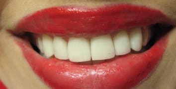 Smile gallery case 13, after