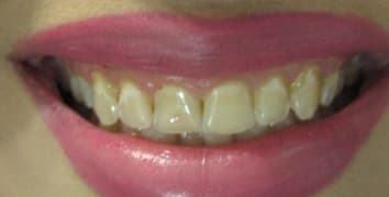 Smile gallery case 13, before