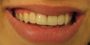 Smile gallery case 15, after