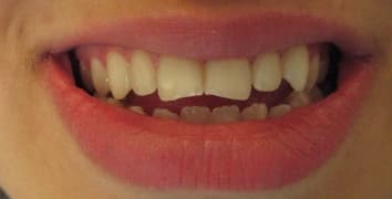 Smile gallery case 15, before