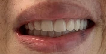 Smile gallery case 16, after