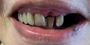 Smile gallery case 16, before