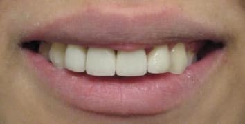 Smile gallery case 17, after