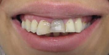 Smile gallery case 17, before