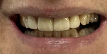 Smile gallery case 7, after