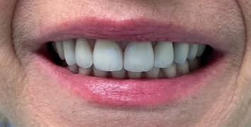 Smile gallery case 5, after