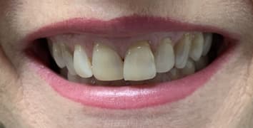 Smile gallery case 5, before