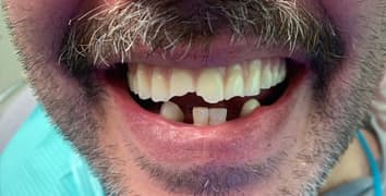 Smile gallery case 3, before