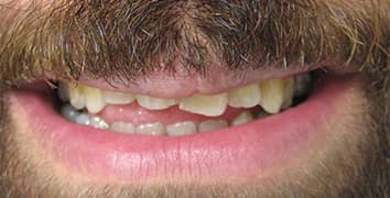 Smile gallery case 19, before