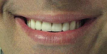 Smile gallery case 20, after