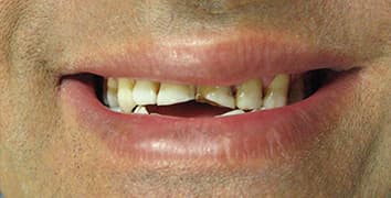 Smile gallery case 20, before