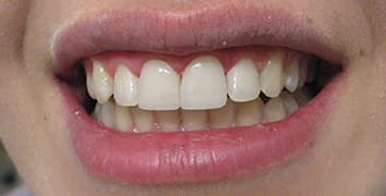 Smile gallery case 21, after