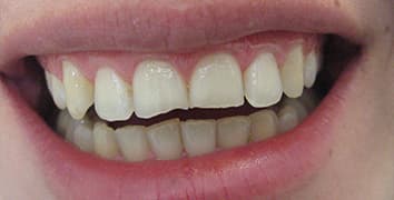 Smile gallery case 21, before