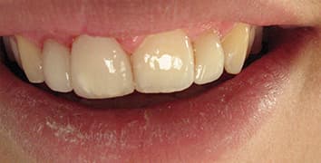 Smile gallery case 22, after