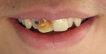 Smile gallery case 22, before