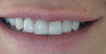 Smile gallery case 23, after