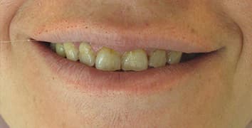 Smile gallery case 23, before