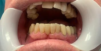 Smile gallery case 24, after