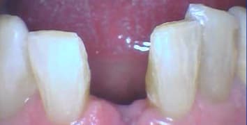 Smile gallery case 24, before
