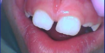 Smile gallery case 25, after