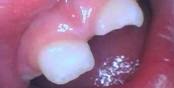 Smile gallery case 25, before