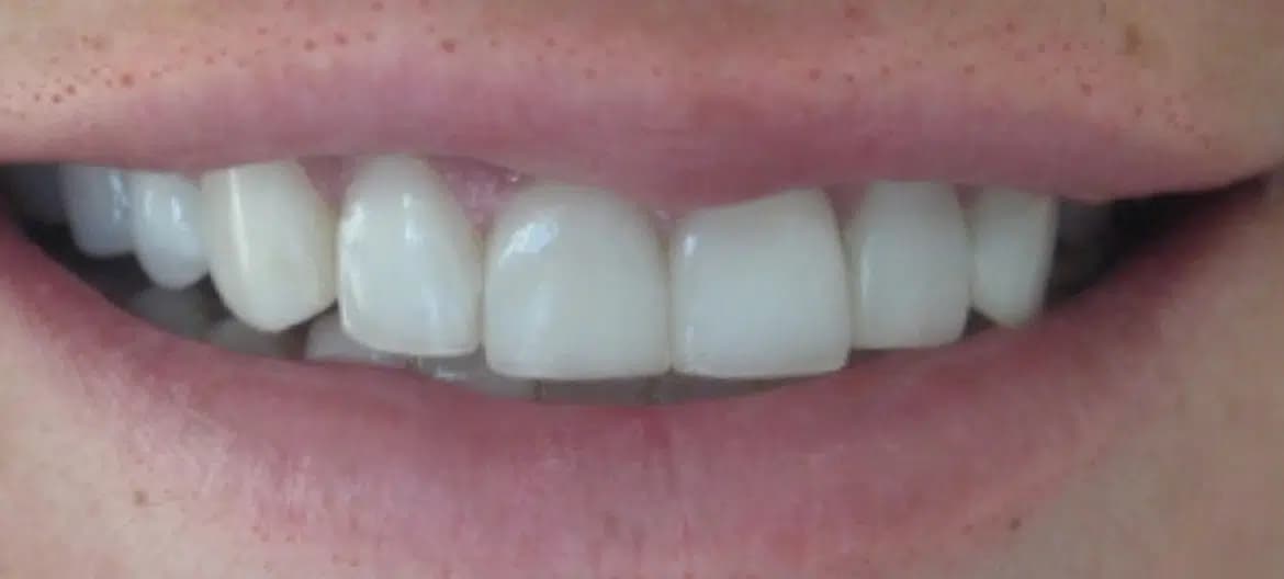 Smile after treatment, case 2