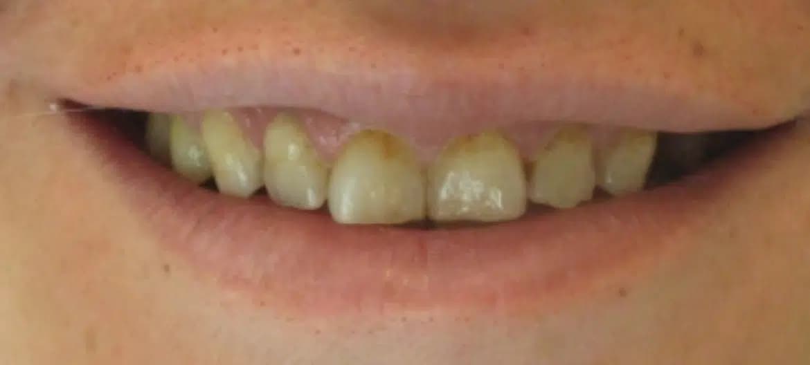 Smile before treatment, case 2