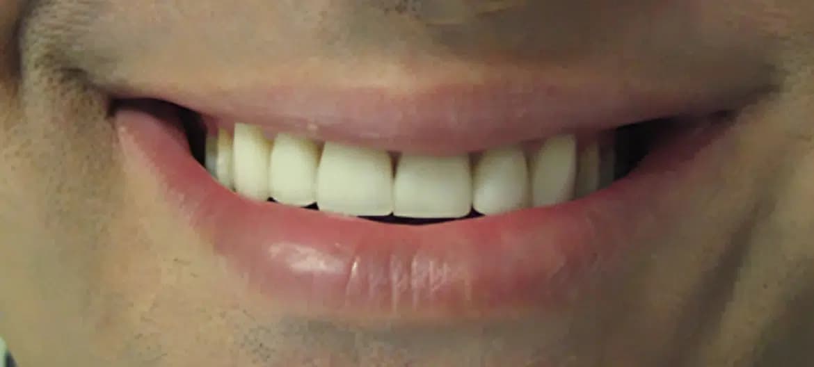 Smile after treatment, case 1