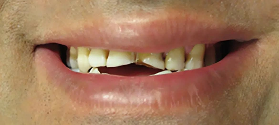 Smile before treatment, case 1