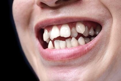 crowded teeth treatment in Burke, VA