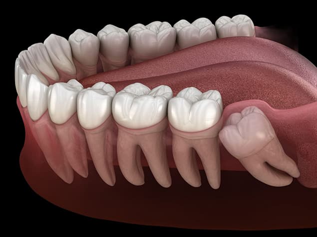 Wisdom Tooth Extractions